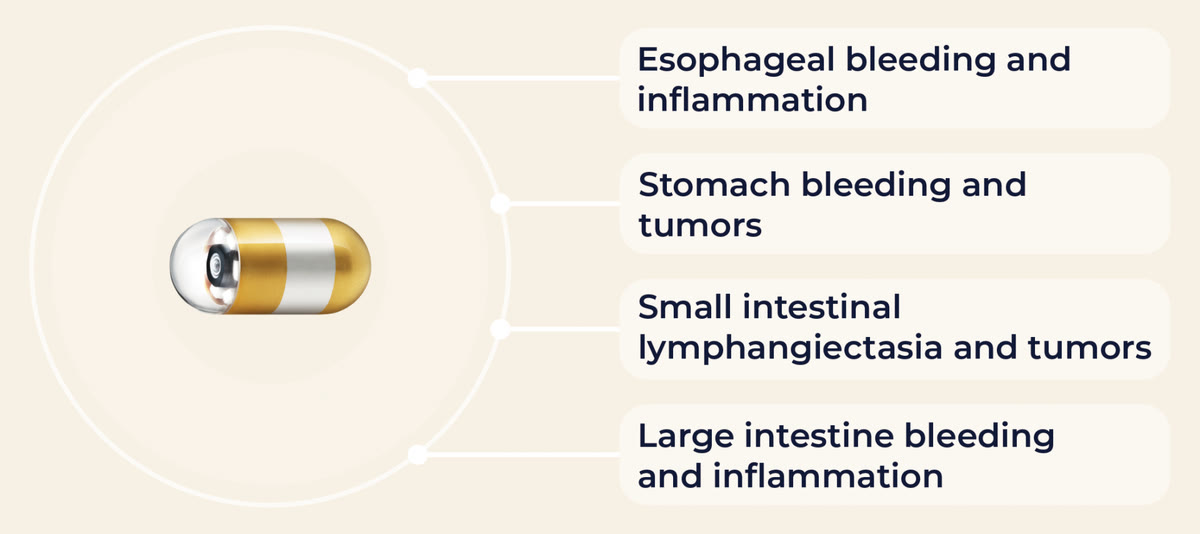 What the capsule can find along the way: esophageal bleeding and inflammation, stomach bleeding and tumors, small-intestinal lymphangiectasia and tumors, and large-intestine bleeding and inflammation