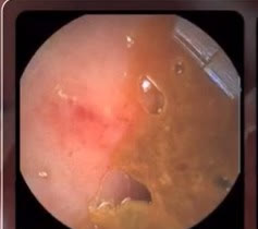 Capsule camera image: angiodysplasia