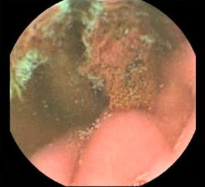 Capsule camera image: foreign body