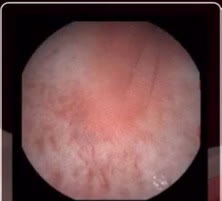 Capsule camera image: hyperemia