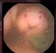 Capsule camera image: ileocolic valve bleed