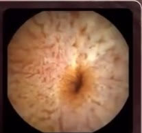 Capsule camera image: lymphangiectasia