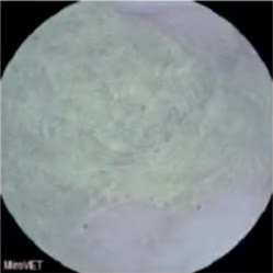 Capsule camera image: trichobezoar (hairball)