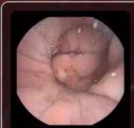 Capsule camera image: tumor